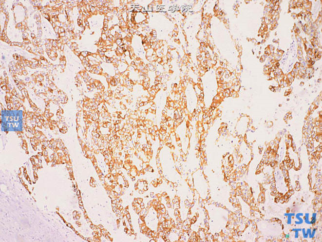 尿道腺癌，免疫组化：CK8、18（+）