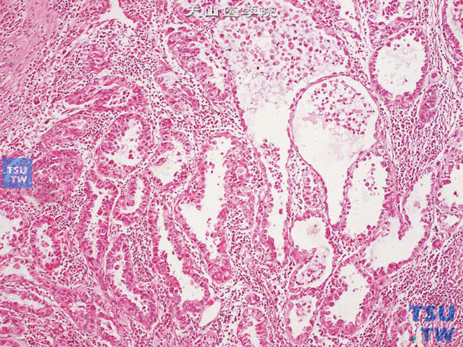 尿道透明细胞腺癌，肿瘤呈管状-囊状结构，胞质透明或嗜酸，可见钉突状细胞