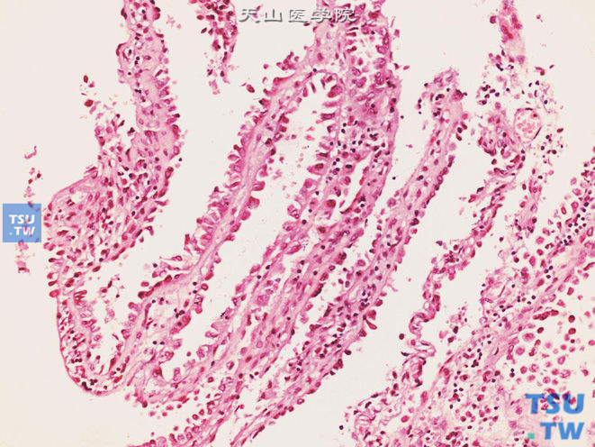 尿道透明细胞腺癌，示钉突状细胞