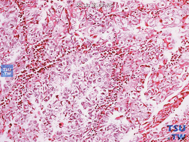 尿道透明细胞腺癌，示瘤细胞胞质透明，核异型明显