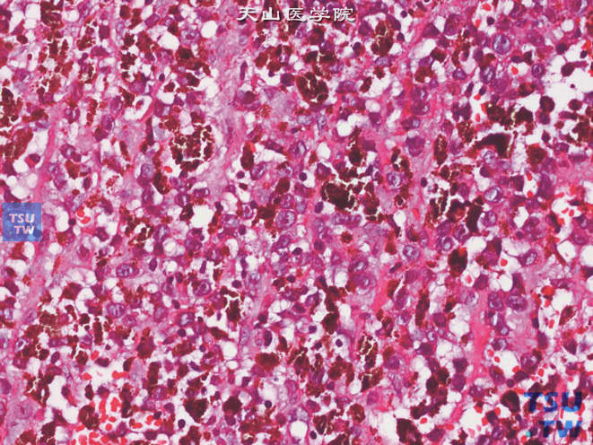 尿道口恶性黑色素瘤，部分区域色素较丰富，可掩盖其细胞特征