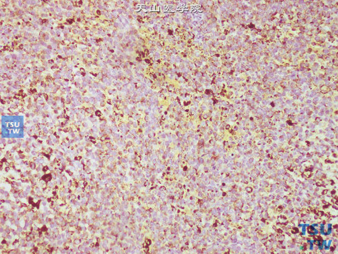 尿道口恶性黑色素瘤，免疫组化：HMB45（+）