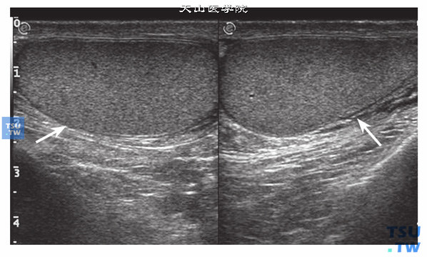 正常睾丸超声图像特点：正常睾丸外形是卵圆形，左右各一，内部低回声，光点细密，分布均匀。环绕睾丸外周有一条强回声白膜光环，光滑整齐。睾丸大小随年龄不同，成人睾丸4cm×3cm×2cm（长×宽×厚）