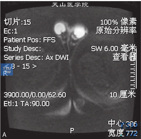 图A：CT-正常睾丸，男，23岁，睾丸坠胀感。双侧睾丸体积正常，白膜光整，其内未见异常信号，DWI未见异常信号，增强后未见异常强化