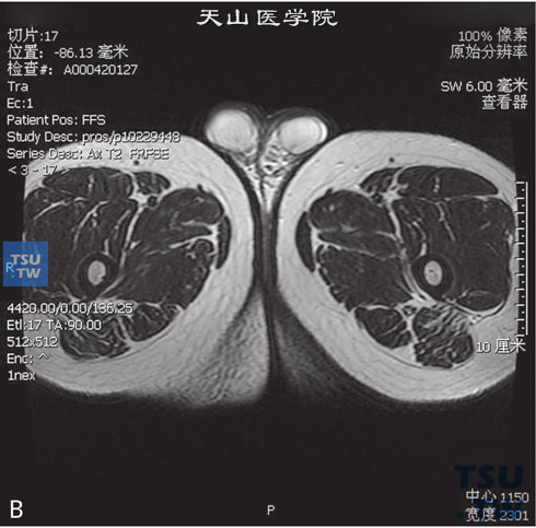 图B：CT-正常睾丸，男，23岁，睾丸坠胀感。双侧睾丸体积正常，白膜光整，其内未见异常信号，DWI未见异常信号，增强后未见异常强化