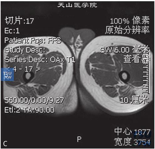 图C：CT-正常睾丸，男，23岁，睾丸坠胀感。双侧睾丸体积正常，白膜光整，其内未见异常信号，DWI未见异常信号，增强后未见异常强化