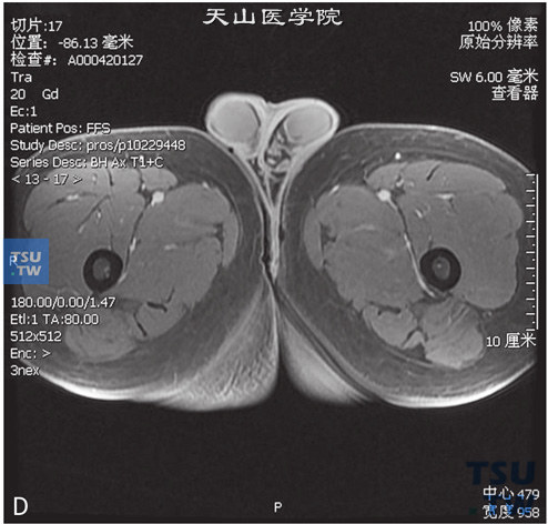 图D：CT-正常睾丸，男，23岁，睾丸坠胀感。双侧睾丸体积正常，白膜光整，其内未见异常信号，DWI未见异常信号，增强后未见异常强化