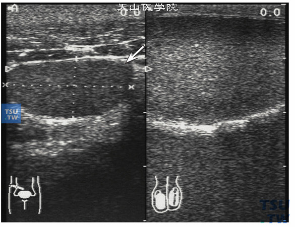 睾丸发育异常（B超） 左图提示发育不良的睾丸，箭头指示。右图为正常睾丸结构，左右图对比除体积小外，回声无明显差异