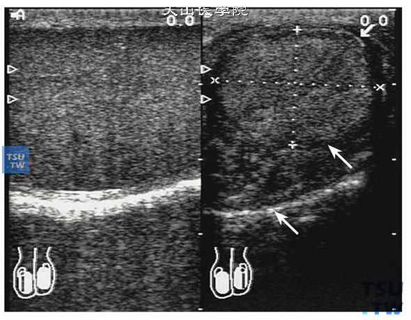 睾丸外伤后萎缩（B超）。左图正常睾丸。右图睾丸外伤后萎缩，表现体积明显缩小，睾丸白膜表面粗糙，睾丸内部回声不均质，回声偏低区是坏死区，内部无血流信号