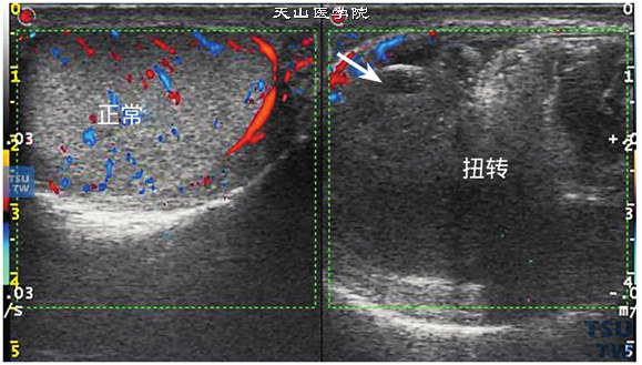 睾丸扭转后坏死超声图像特点：左图正常睾丸超声图像，外形呈卵圆形，内部回声均质，可见正常血流信号。右图睾丸形态失常，体积明显增大，内部回声极不均质，可见多个不规则低回声坏死区，内部未见血流信号