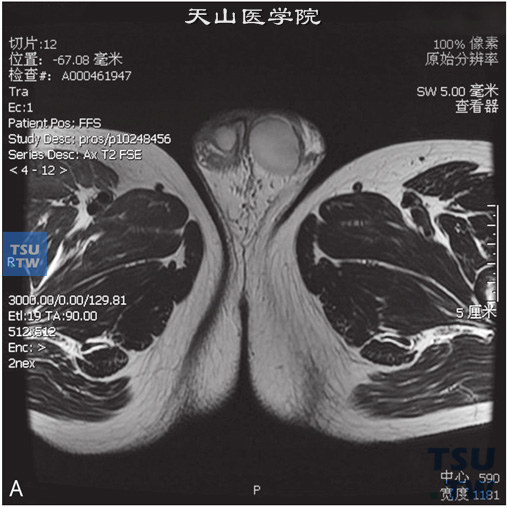 图A：CT，右侧睾丸萎缩，男，32岁，发现一侧睾丸小。右侧睾丸较对侧小，边缘光整，睾丸白膜稍厚，未见异常信号