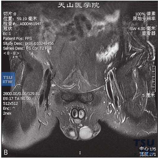 图B：CT，右侧睾丸萎缩，男，32岁，发现一侧睾丸小。右侧睾丸较对侧小，边缘光整，睾丸白膜稍厚，未见异常信号