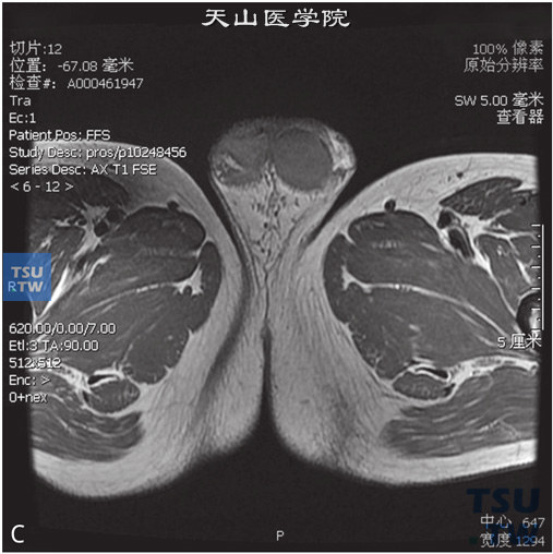 图C：CT，右侧睾丸萎缩，男，32岁，发现一侧睾丸小。右侧睾丸较对侧小，边缘光整，睾丸白膜稍厚，未见异常信号