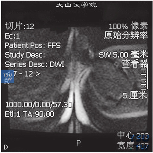 图D：CT，右侧睾丸萎缩，男，32岁，发现一侧睾丸小。右侧睾丸较对侧小，边缘光整，睾丸白膜稍厚，未见异常信号