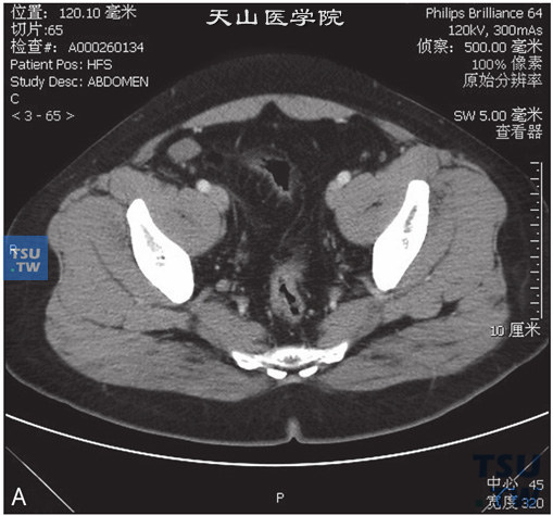 图A：CT，双侧隐睾，男，31岁，双侧隐睾。右侧盆腔及左侧腹股沟管内分别见软组织密度结节，边缘清晰，冠状位于右侧腹股沟管内可见鞘突