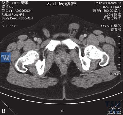 图B：CT，双侧隐睾，男，31岁，双侧隐睾。右侧盆腔及左侧腹股沟管内分别见软组织密度结节，边缘清晰，冠状位于右侧腹股沟管内可见鞘突