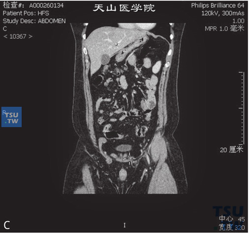 图C：CT，双侧隐睾，男，31岁，双侧隐睾。右侧盆腔及左侧腹股沟管内分别见软组织密度结节，边缘清晰，冠状位于右侧腹股沟管内可见鞘突
