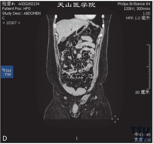 图D：CT，双侧隐睾，男，31岁，双侧隐睾。右侧盆腔及左侧腹股沟管内分别见软组织密度结节，边缘清晰，冠状位于右侧腹股沟管内可见鞘突