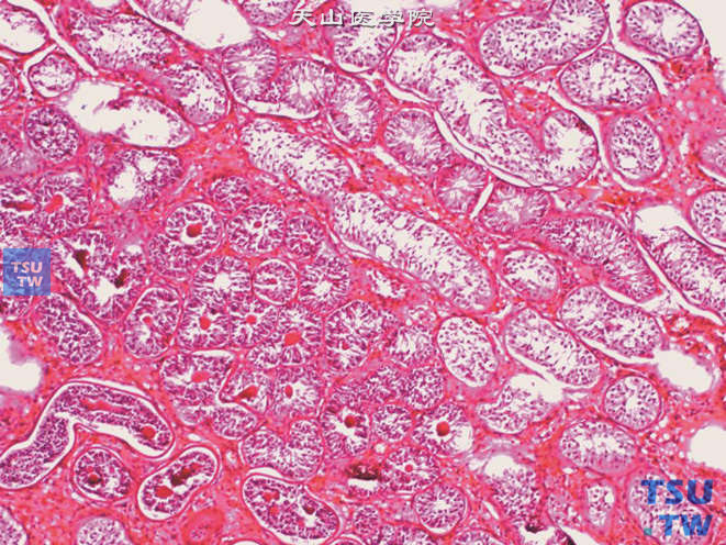 隐睾，示未成熟的小管聚集在一起，呈Pick腺瘤表现