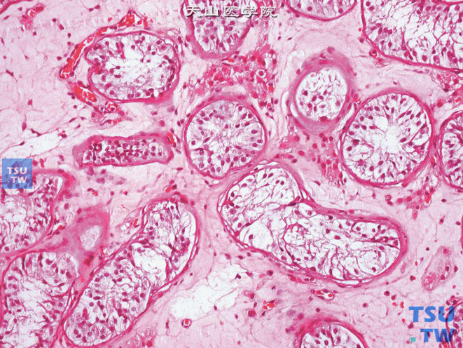 隐睾。曲细精管生精细胞消失，仅见支持细胞，间质结缔组织增生