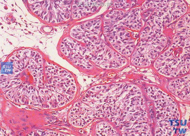 睾丸曲细精管唯支持细胞综合征，幼稚支持细胞型。支持细胞呈青春期前的假复层结构