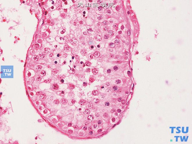 睾丸活检，曲细精管生精细胞发育障碍，可见精原细胞、精母细胞及精子细胞，但未见精子形成