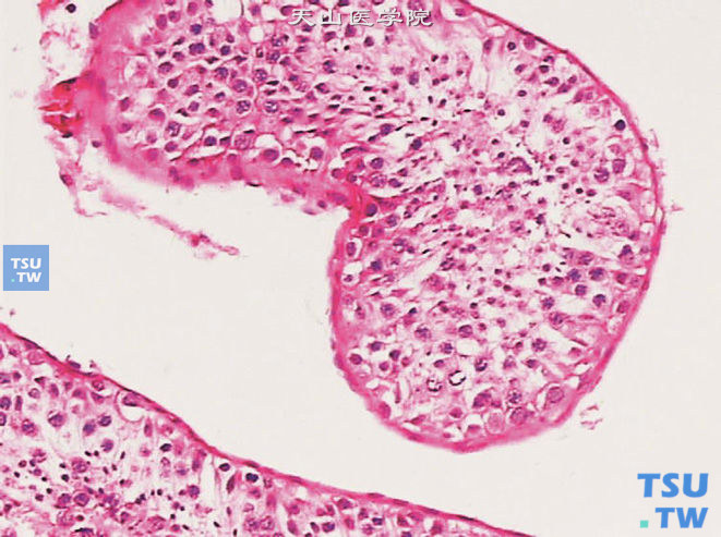 梗阻性无精症之曲细精管，可见各级生精细胞及精子