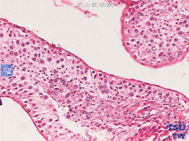 梗阻性无精症之曲细精管，可见各级生精细胞及精子，但生精细胞排列较紊乱，可见脱落的细胞堵塞管腔
