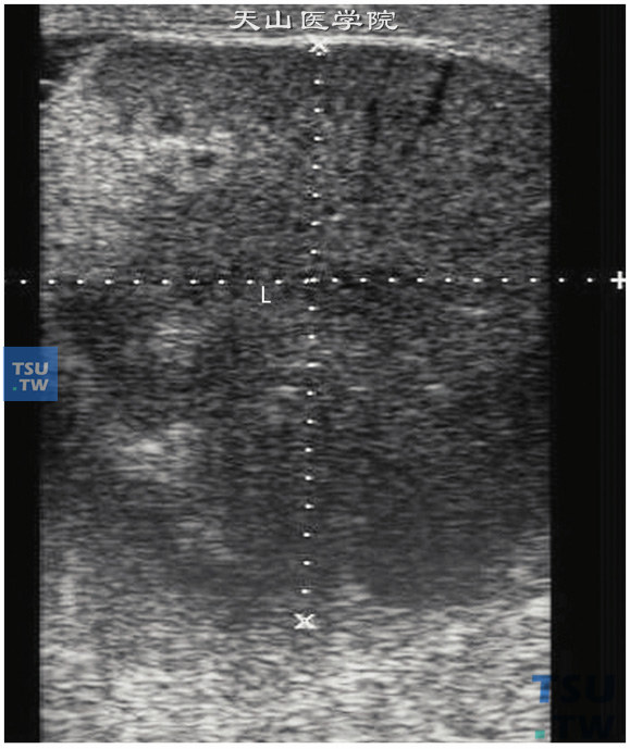 睾丸肉芽肿性炎。患者发烧并左睾丸肿大7天。左睾丸5.0cm×4.3cm×3.9cm。急性期睾丸体积呈弥漫性增大，外形规则，内部回声不均质，灶性或弥漫性低回声，炎症严重时睾丸内可见大片低回声，脓肿形成时可见局限性液性暗区；可同时伴有阴囊壁增厚，回声增强。血流信号增多。慢性期睾丸体积缩小，内部回声不均略增强，睾丸表面不光滑。血流信号减少或无血流信号即睾丸萎缩