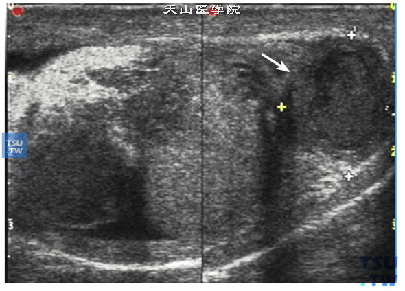 睾丸附睾结核超声图像特点：附睾结核为男性生殖系结核的好发部位，附睾的干酪样病变很快蔓延到附睾之外，与阴囊黏连，形成寒性脓肿，破溃流脓。也可直接蔓延至睾丸，引起睾丸结核，该病例为典型的附睾睾丸结核，睾丸及附睾正常结构完全消失，体积弥漫性增大，回声极不均质呈混合回声改变，有典型的干酪样坏死灶，不均质低回声伴声晕（箭头指示），钙盐沉积时声像图出现强回声光斑或光团，附睾睾丸或与阴囊壁黏连，声像图出现睾丸附睾及阴囊壁界限不清，回声杂乱