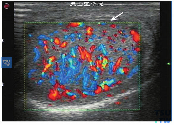 睾丸附睾结核血流超声图像特点：在结核早期，血流极为丰富，血管分布杂乱；在结核已形成寒性脓肿，干酪样坏死灶时，睾丸及附睾内的血流信号会明显减少。该病例为结核早期，睾丸肿大，无脓肿及坏死灶，内部血流极为丰富，血管杂乱