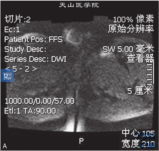 图A：CT，睾丸肉芽肿性炎，男，右侧睾丸及右下腹疼痛、肿胀。右侧睾丸呈T1WI低信号T2WI高信号灶，DWI呈高信号，右侧腹股沟内亦可见条状T2WI略高信号，边缘清，内部见囊性无强化坏死区。增强后，两者均可见较明显强化