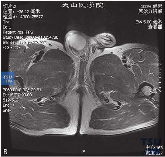 图B：CT，睾丸肉芽肿性炎，男，右侧睾丸及右下腹疼痛、肿胀。右侧睾丸呈T1WI低信号T2WI高信号灶，DWI呈高信号，右侧腹股沟内亦可见条状T2WI略高信号，边缘清，内部见囊性无强化坏死区。增强后，两者均可见较明显强化