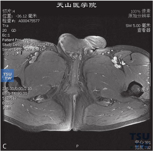 图C：CT，睾丸肉芽肿性炎，男，右侧睾丸及右下腹疼痛、肿胀。右侧睾丸呈T1WI低信号T2WI高信号灶，DWI呈高信号，右侧腹股沟内亦可见条状T2WI略高信号，边缘清，内部见囊性无强化坏死区。增强后，两者均可见较明显强化