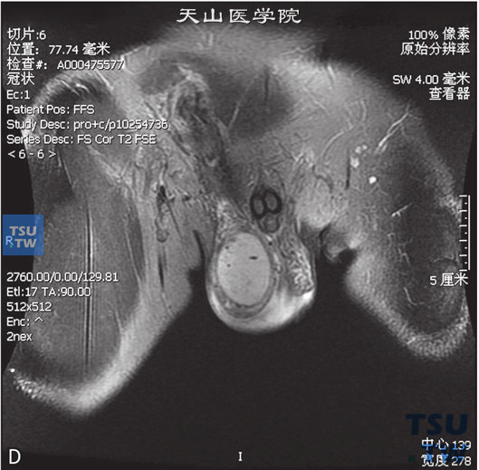 图D：CT，睾丸肉芽肿性炎，男，右侧睾丸及右下腹疼痛、肿胀。右侧睾丸呈T1WI低信号T2WI高信号灶，DWI呈高信号，右侧腹股沟内亦可见条状T2WI略高信号，边缘清，内部见囊性无强化坏死区。增强后，两者均可见较明显强化