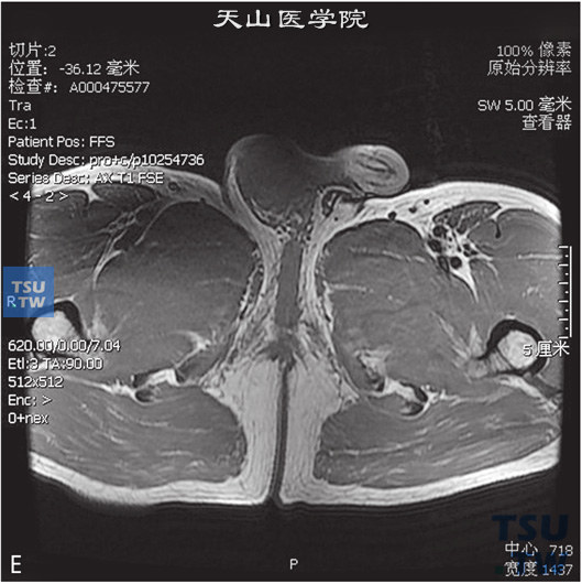 图E：CT，睾丸肉芽肿性炎，男，右侧睾丸及右下腹疼痛、肿胀。右侧睾丸呈T1WI低信号T2WI高信号灶，DWI呈高信号，右侧腹股沟内亦可见条状T2WI略高信号，边缘清，内部见囊性无强化坏死区。增强后，两者均可见较明显强化