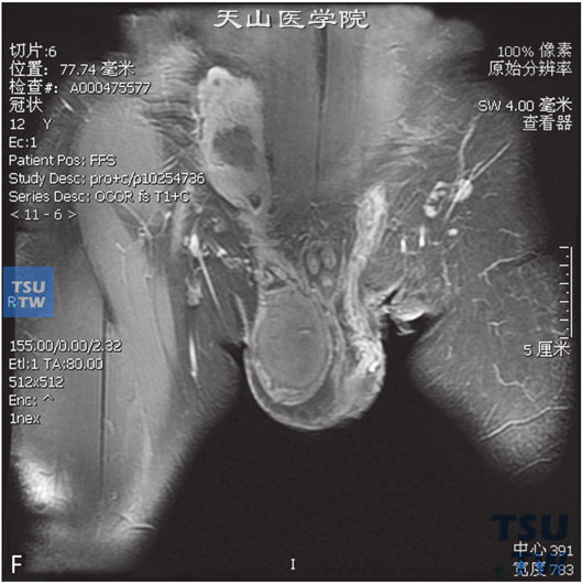 图F：CT，睾丸肉芽肿性炎，男，右侧睾丸及右下腹疼痛、肿胀。右侧睾丸呈T1WI低信号T2WI高信号灶，DWI呈高信号，右侧腹股沟内亦可见条状T2WI略高信号，边缘清，内部见囊性无强化坏死区。增强后，两者均可见较明显强化