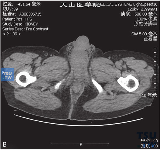 图B：CT，睾丸阴茎结核，男，35岁，肺结核12年，发现阴茎及会阴部皮肤增厚，局部水肿。阴茎海绵体根部见囊状低密度灶，边缘清晰，增强后低密度灶强化不明显，矢状位可见病变累及阴茎根部及阴囊