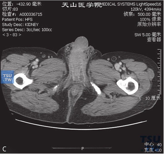 图C：CT，睾丸阴茎结核，男，35岁，肺结核12年，发现阴茎及会阴部皮肤增厚，局部水肿。阴茎海绵体根部见囊状低密度灶，边缘清晰，增强后低密度灶强化不明显，矢状位可见病变累及阴茎根部及阴囊
