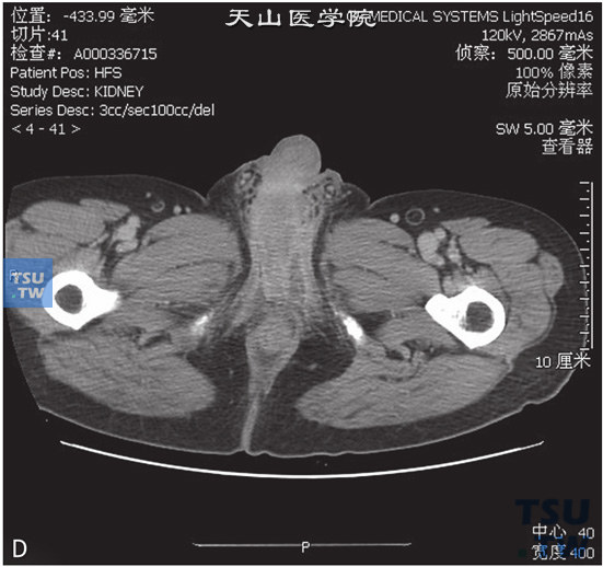 图D：CT，睾丸阴茎结核，男，35岁，肺结核12年，发现阴茎及会阴部皮肤增厚，局部水肿。阴茎海绵体根部见囊状低密度灶，边缘清晰，增强后低密度灶强化不明显，矢状位可见病变累及阴茎根部及阴囊