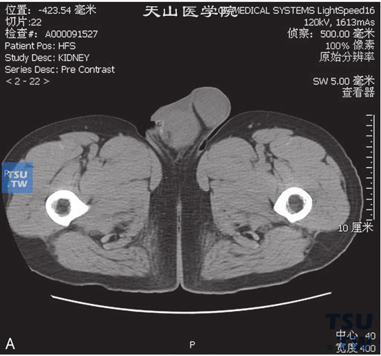 图A：CT，睾丸阴茎阴囊结核，男，40岁，阴囊及阴茎皮肤增厚，阴囊及阴茎内见片状略高密度灶，边缘欠清晰，阴囊及会阴皮肤明显增厚