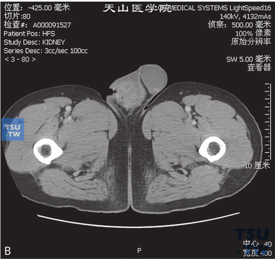 图B：CT，睾丸阴茎阴囊结核，男，40岁，阴囊及阴茎皮肤增厚，阴囊及阴茎内见片状略高密度灶，边缘欠清晰，阴囊及会阴皮肤明显增厚