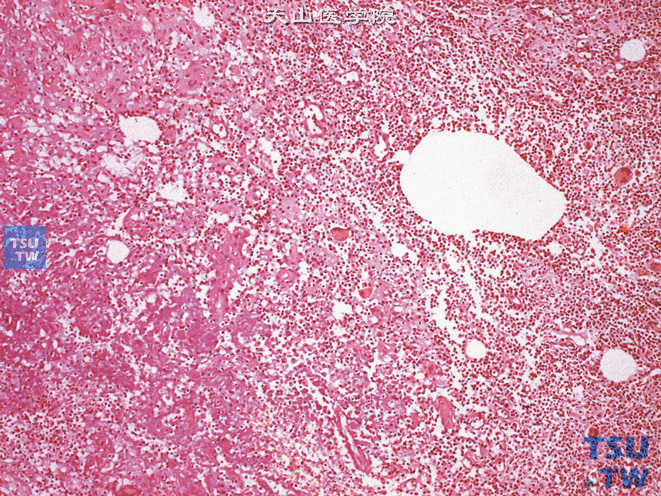 睾丸肉芽肿性炎，可见多种炎细胞、多核巨细胞浸润及坏死