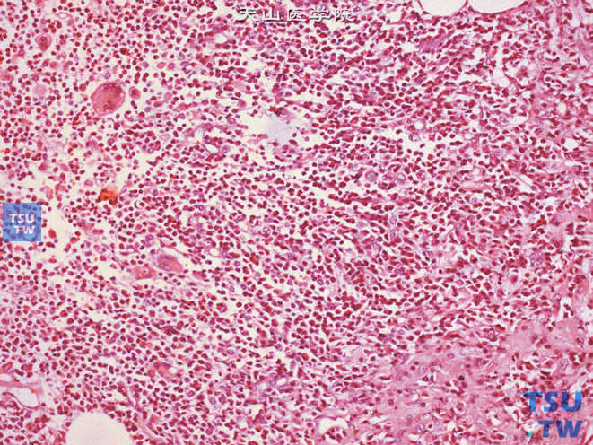 睾丸肉芽肿性炎，可见多种炎细胞及多核巨细胞浸润
