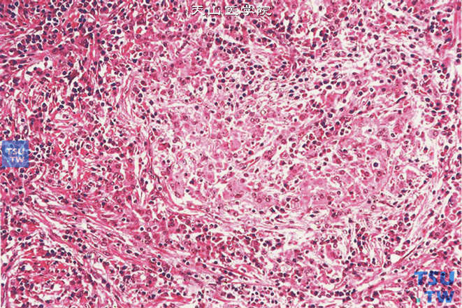 睾丸软斑病，可见胞质嗜酸的巨噬细胞浸润，导致曲细精管破坏