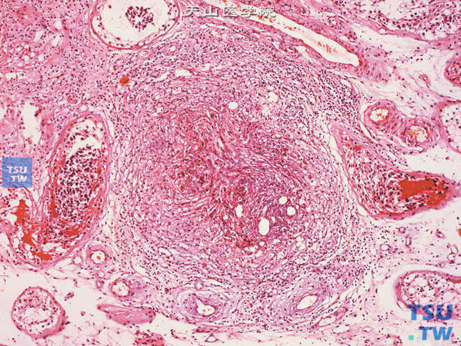 睾丸精子肉芽肿，可见由精子碎屑所致的肉芽肿性炎