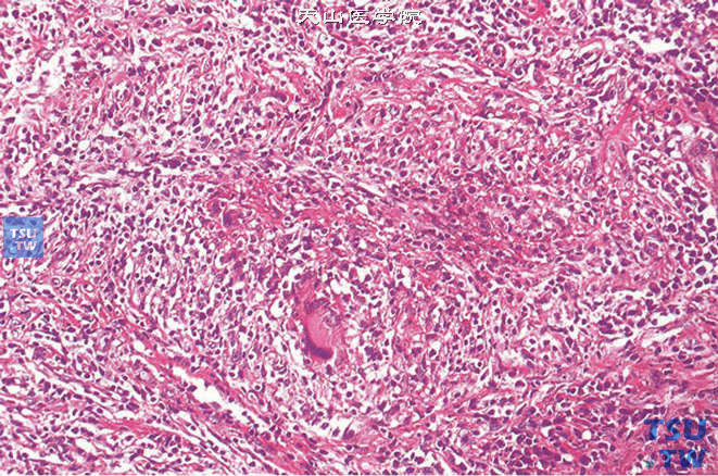 睾丸梅毒，可见淋巴细胞、浆细胞和巨细胞浸润