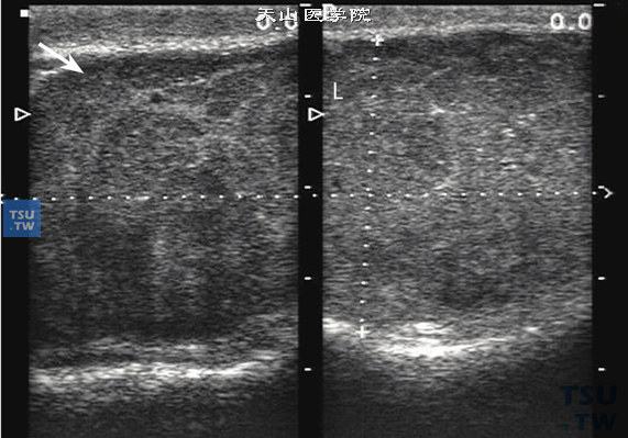 睾丸精原细胞瘤超声图像特点：原发性睾丸肿瘤多为恶性，又分生殖细胞肿瘤和非生殖细胞肿瘤，生殖细胞肿瘤占90%～95%。精原细胞瘤为常见的睾丸生殖细胞肿瘤，多为单侧，偶发双侧，睾丸体积大多弥漫性增大，白膜增厚，外形尚规则，内部呈弥漫性低回声，回声粗糙，正常形态完全消失。该病例男性36岁，双侧精原细胞瘤
