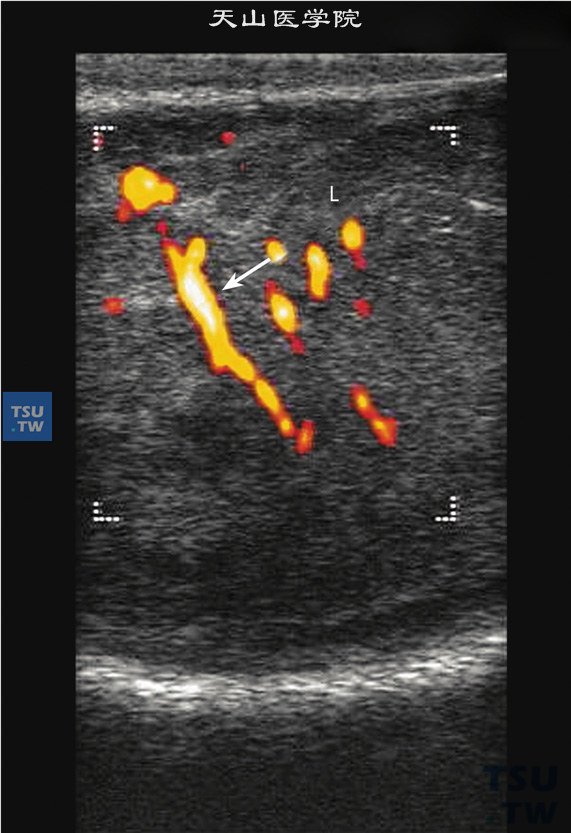 睾丸精原细胞瘤血流超声图像特点：睾丸内部血流非常丰富