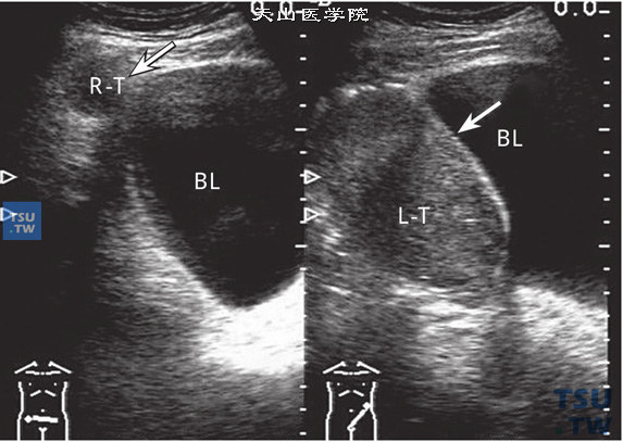 双侧隐睾，继发左侧睾丸精原细胞瘤超声图像特点：隐睾症单侧多见，也可双侧。隐睾通常比正常睾丸体积小，形态与正常睾丸相似，边界清晰，内部回声与正常睾丸无异。CDFI表现睾丸内部血流信号较少。隐睾的恶变率比正常睾丸高45～48倍，恶变时，睾丸外形饱满，体积明显增大，内部回声不均质，而CDFI表现睾丸内的血流明显增多。该病例男性49岁，双侧阴囊内未见睾丸结构，双侧睾丸均位于膀胱外侧左图箭头指示为右侧体积较小的睾丸，右图箭头指示左侧隐睾已恶变，体积明显增大，外形饱满，内部回声低而不均质。病理提示：精原细胞瘤（R-T：右侧睾丸，L-T：左侧睾丸，BL：膀胱）